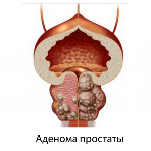 Adenoma prostaty Adenoma prostaty