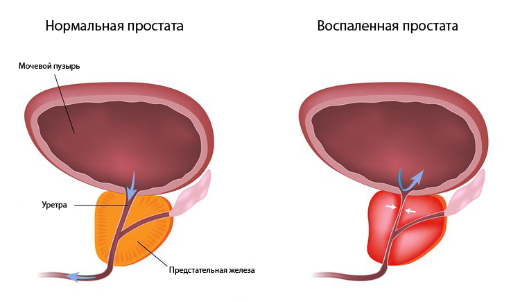 prostatit prostatit