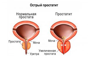 prostatą a seksualność clisma eficientă pentru prostatita