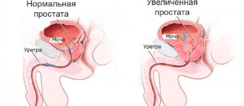 Простатит Простатит